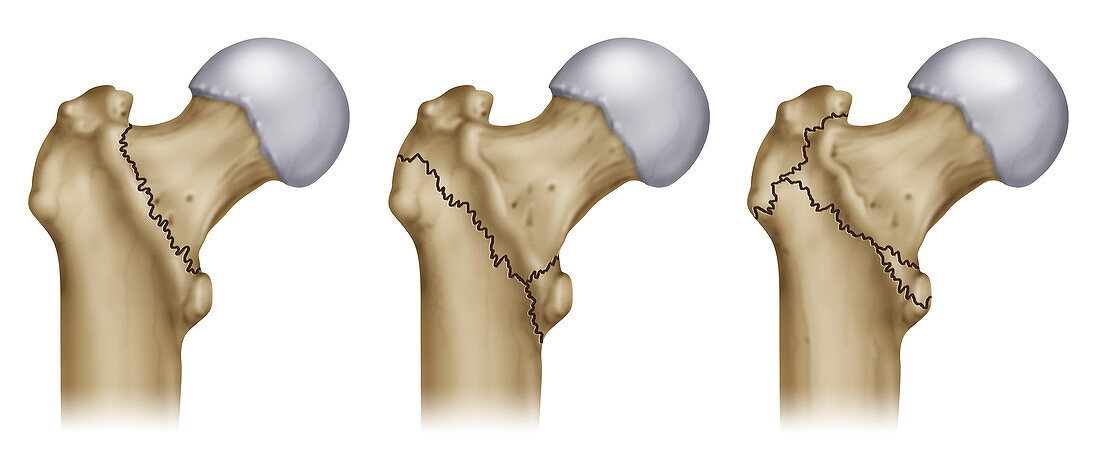 Femur trochanter fractures, illustration