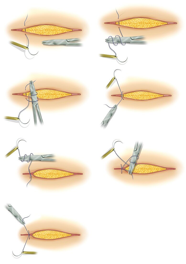 Suturing of surgical incision, illustration