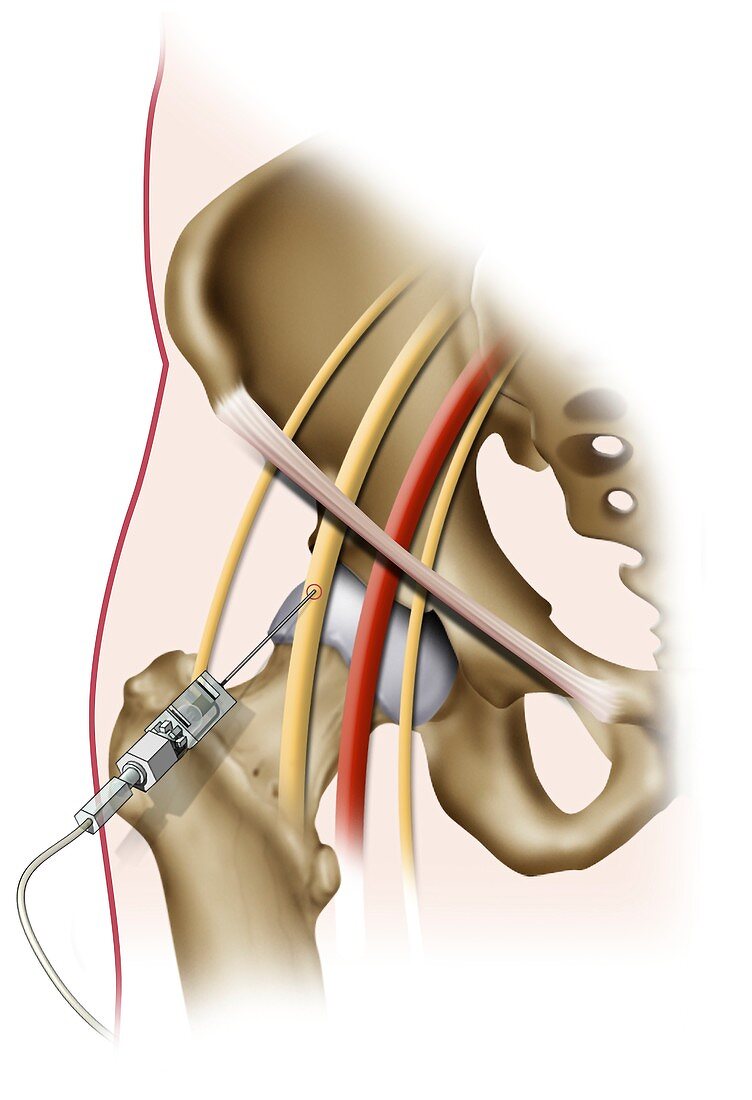 Femoral nerve block injection, illustration