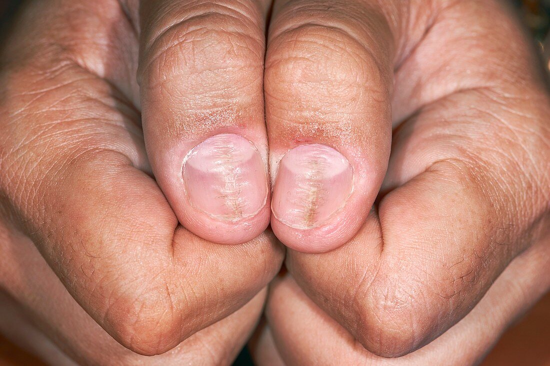 Median nail dystrophy