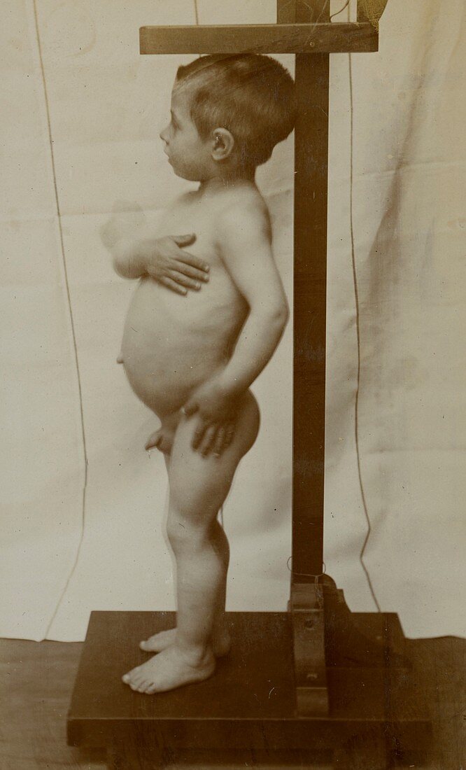 Measuring dwarfism, historical image