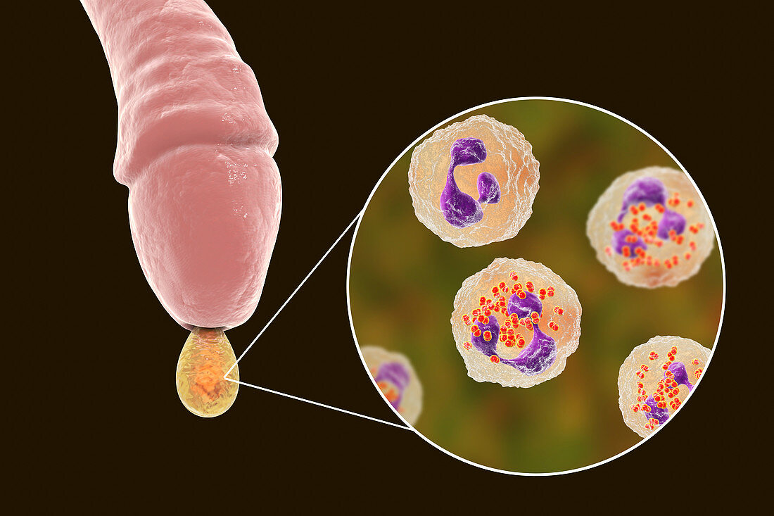 Gonorrhoea infection in male, illustration