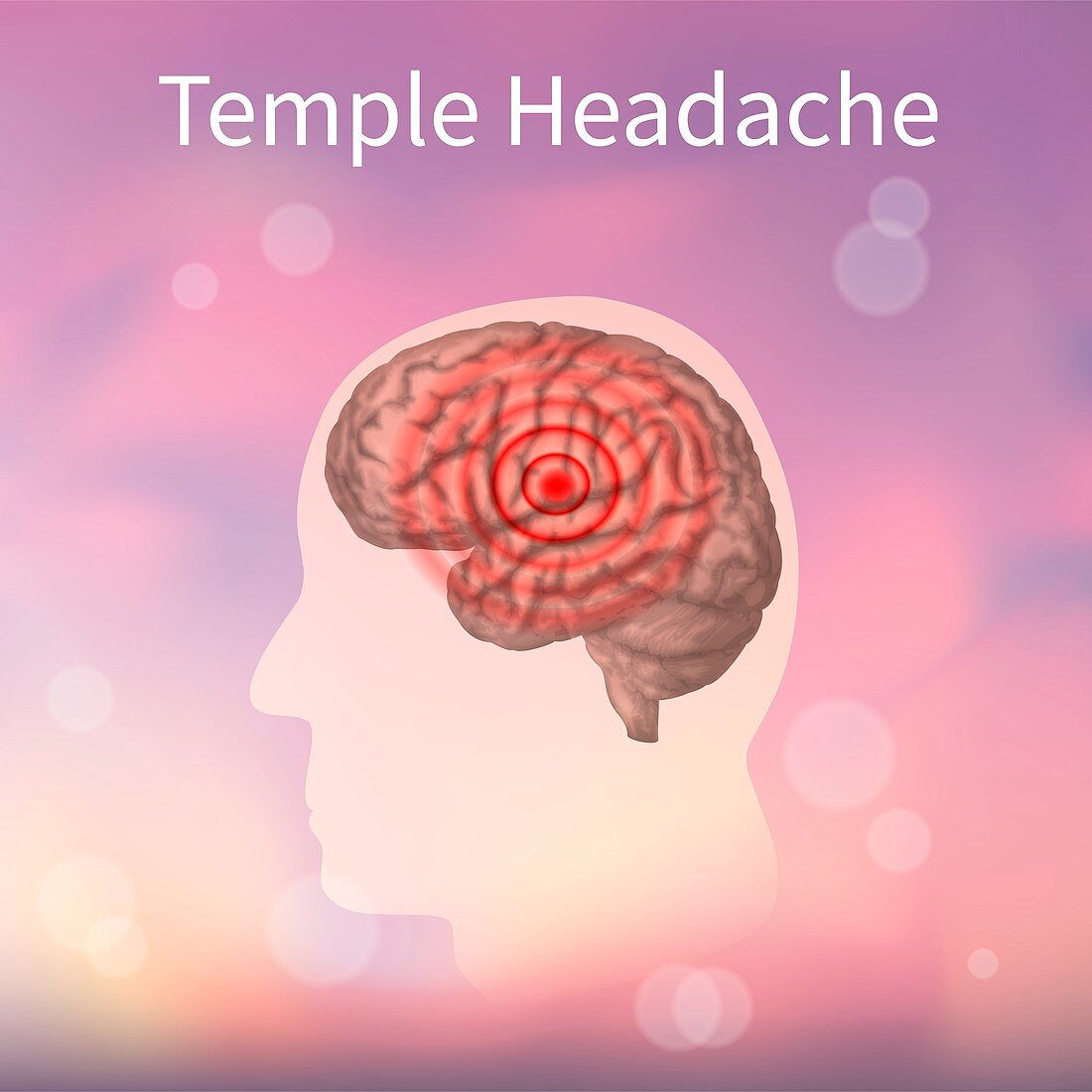 Temple headache, illustration