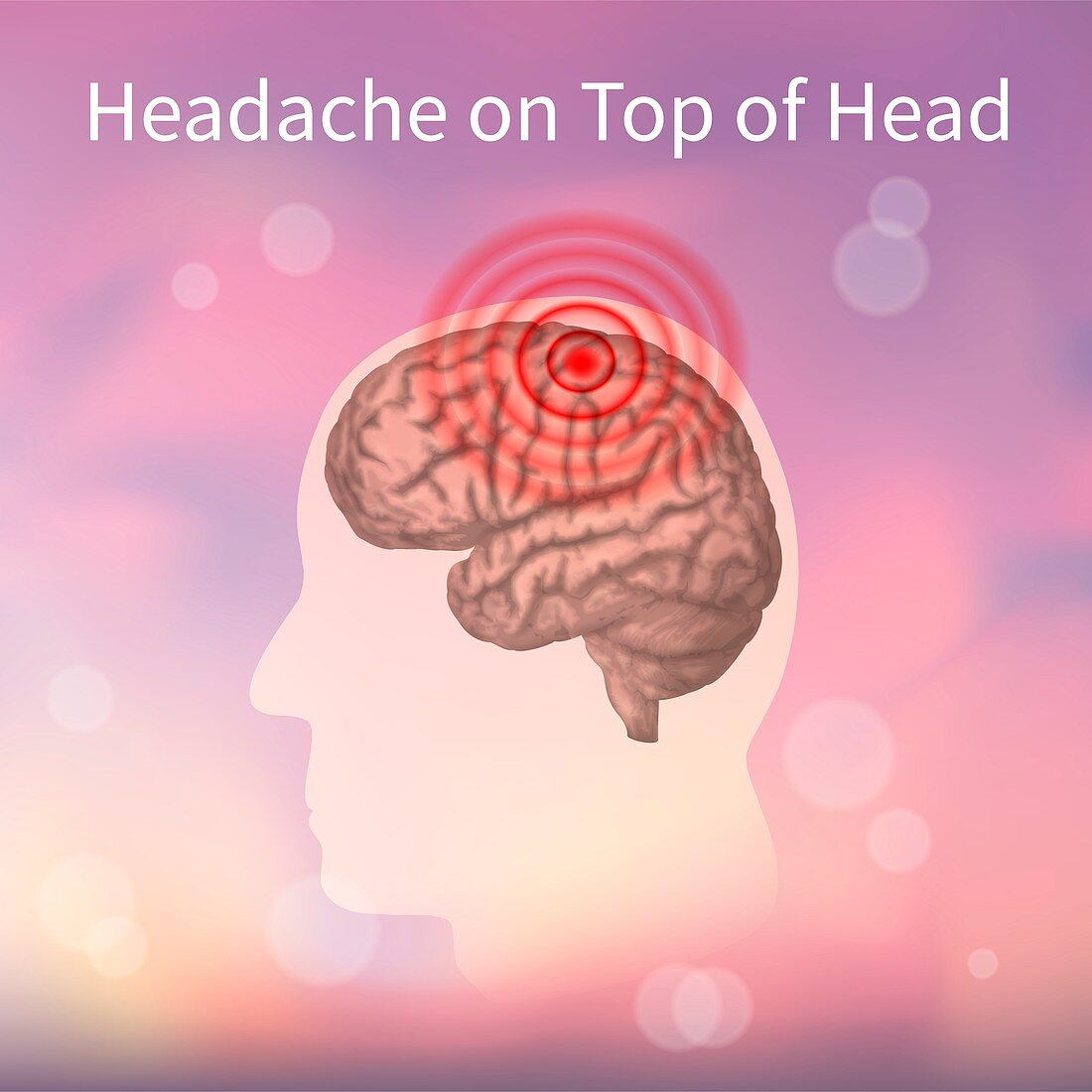 Headache on top of the head, illustration