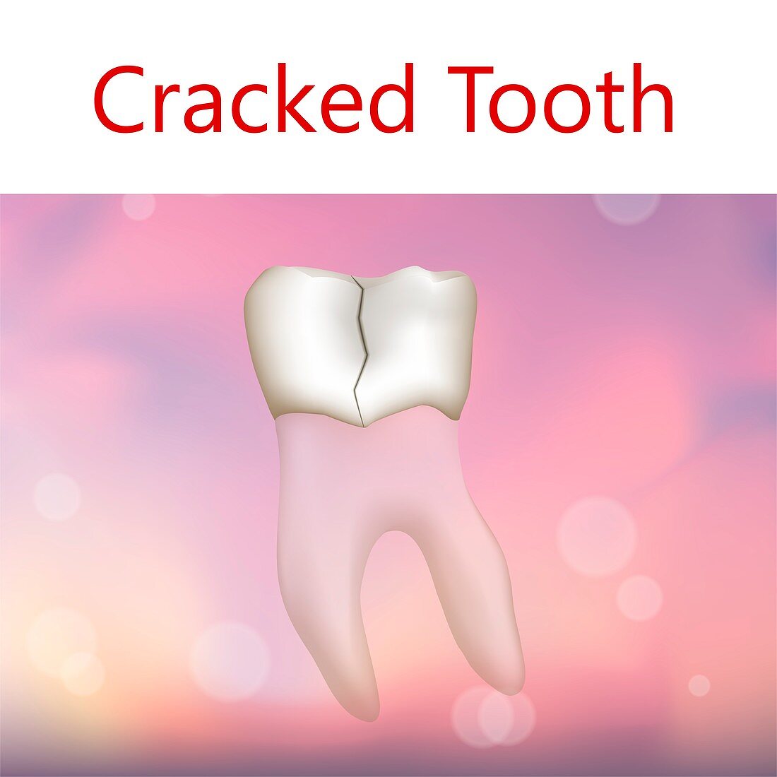 Cracked tooth, illustration