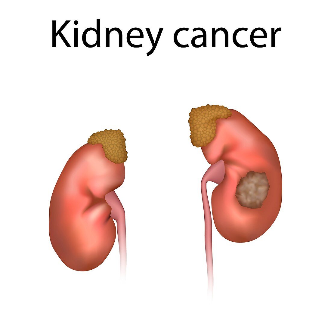 Kidney cancer, illustration