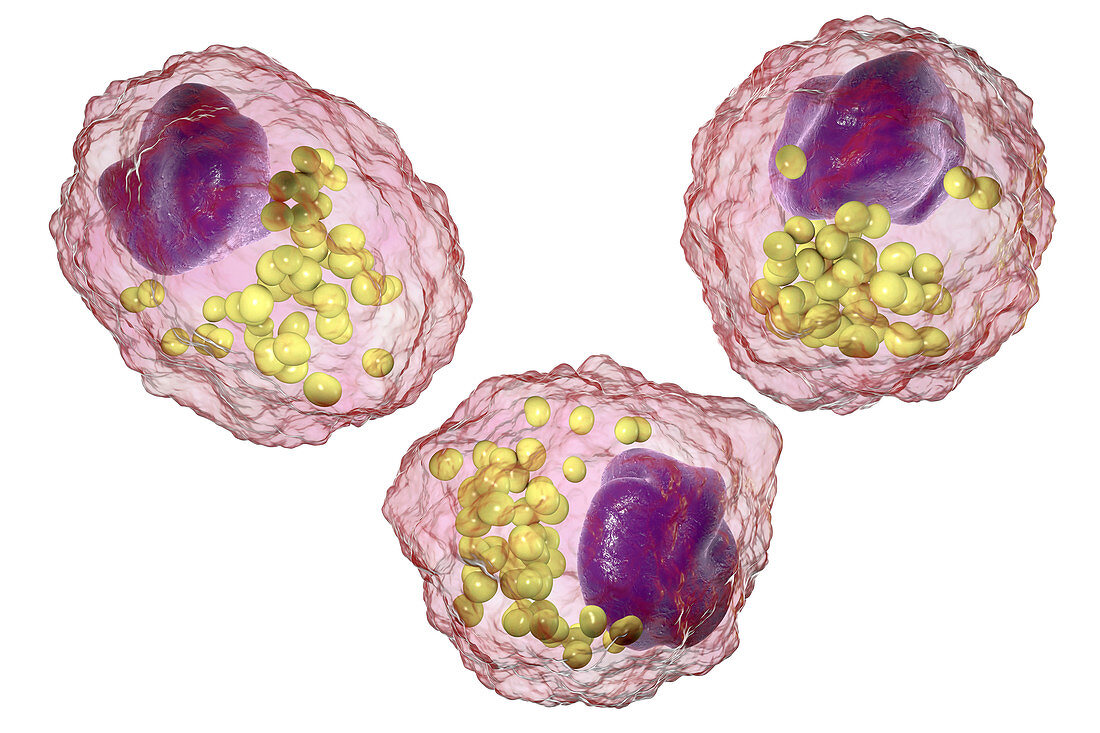 Macrophage foam cell, illustration