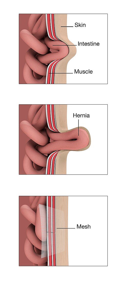 Hernia anatomy and repair, illustration