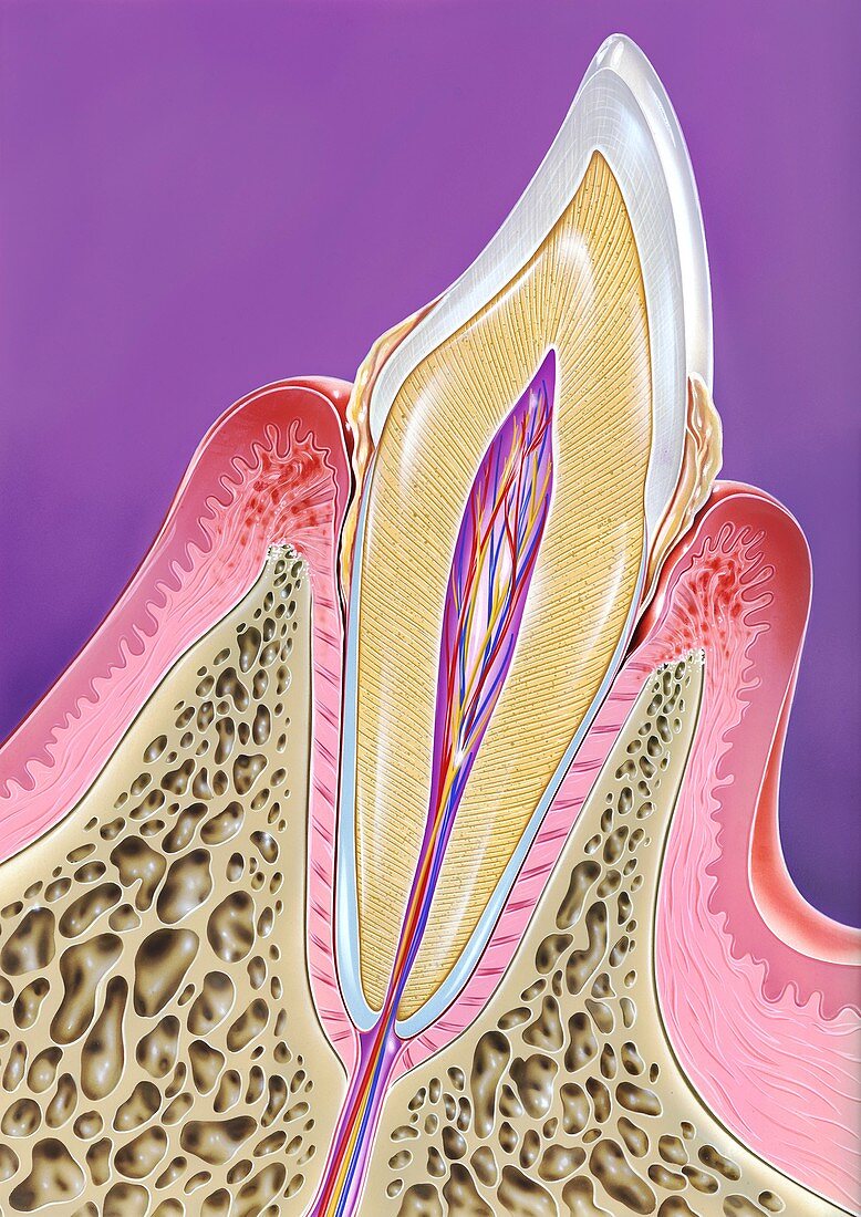 Periodontal disease, illustration