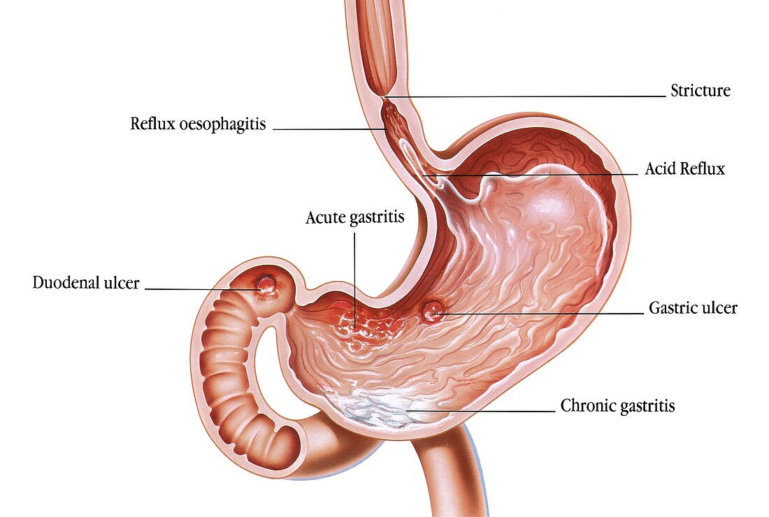 Gastric and duodenal ulcers and acid reflux, illustration