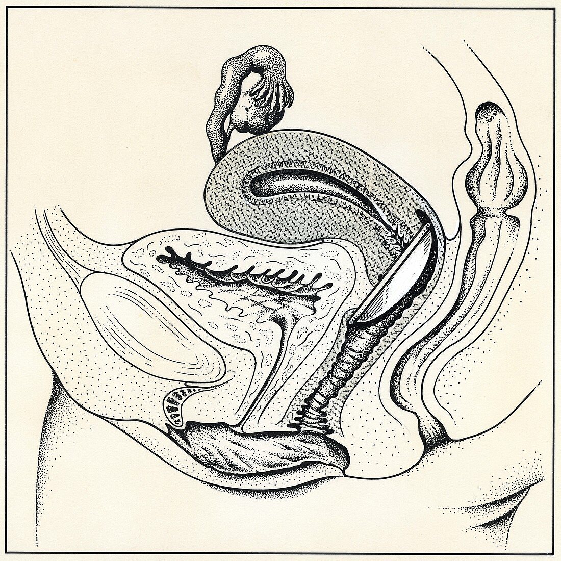 Diaphragm contraceptive in the uterus, illustration