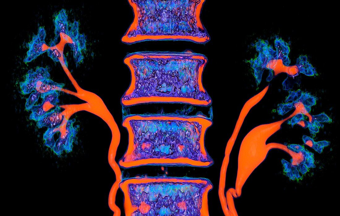 Kidneys and duplicated ureter, CT scan