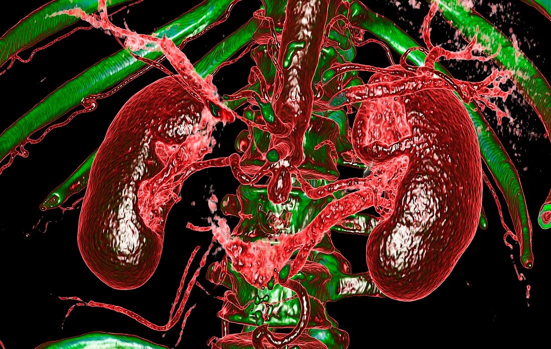 Aortoiliac occlusive disease, 3D CT scan