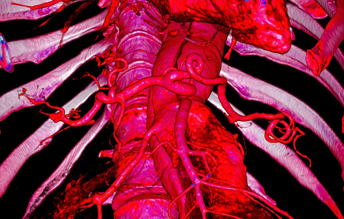 Aortic aneurysms, 3D CT scan