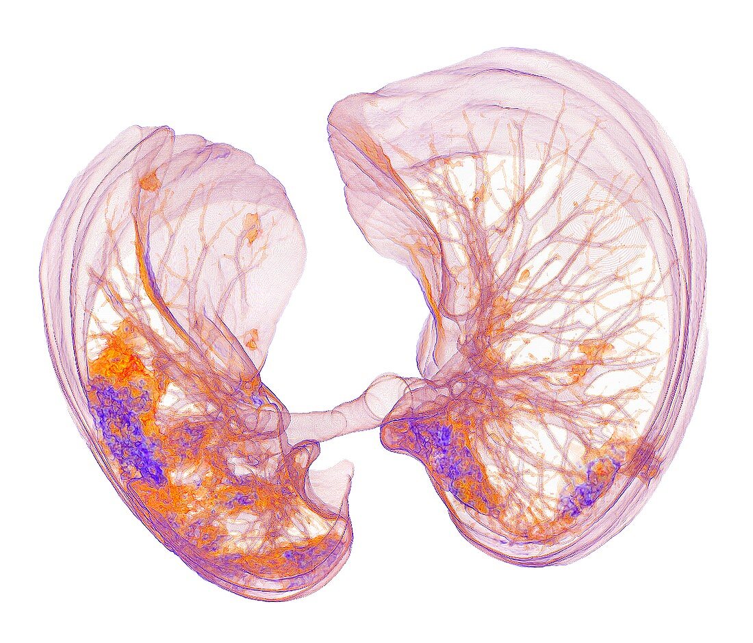 Lungs affected by Covid-19 atypical pneumonia, 3d CT scan