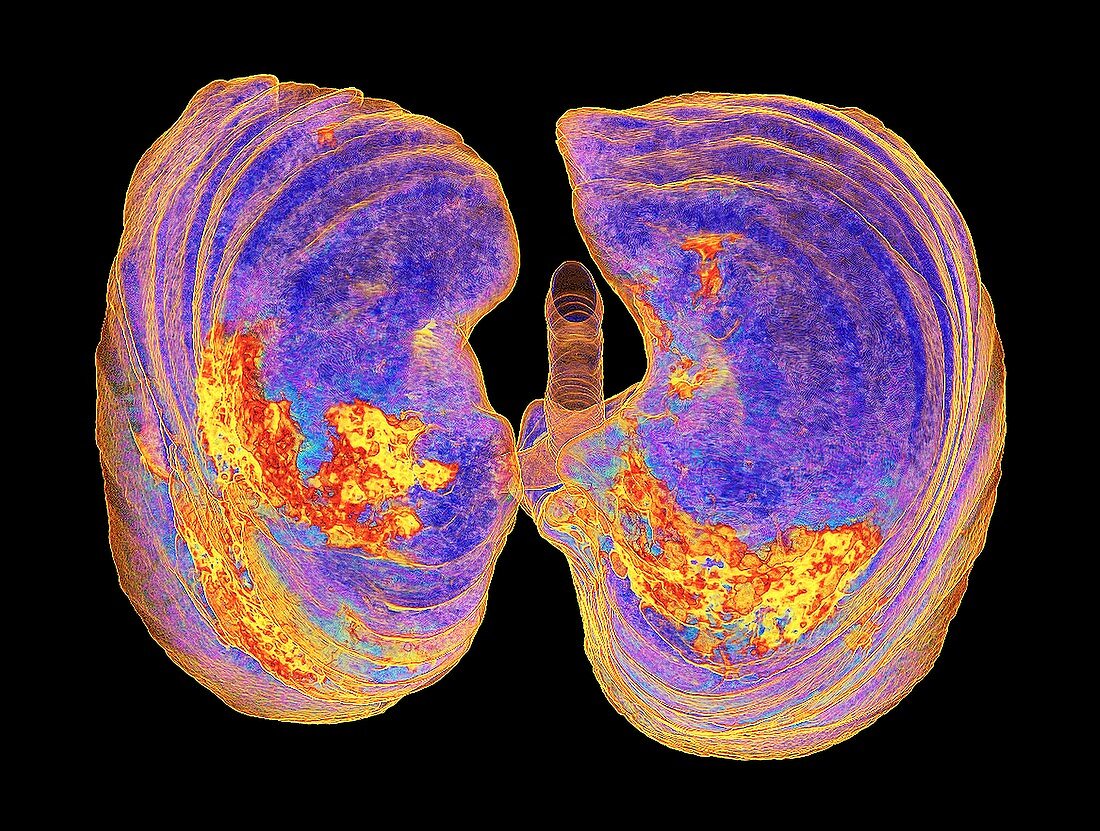 Lungs affected by Covid-19 atypical pneumonia, 3d CT scan