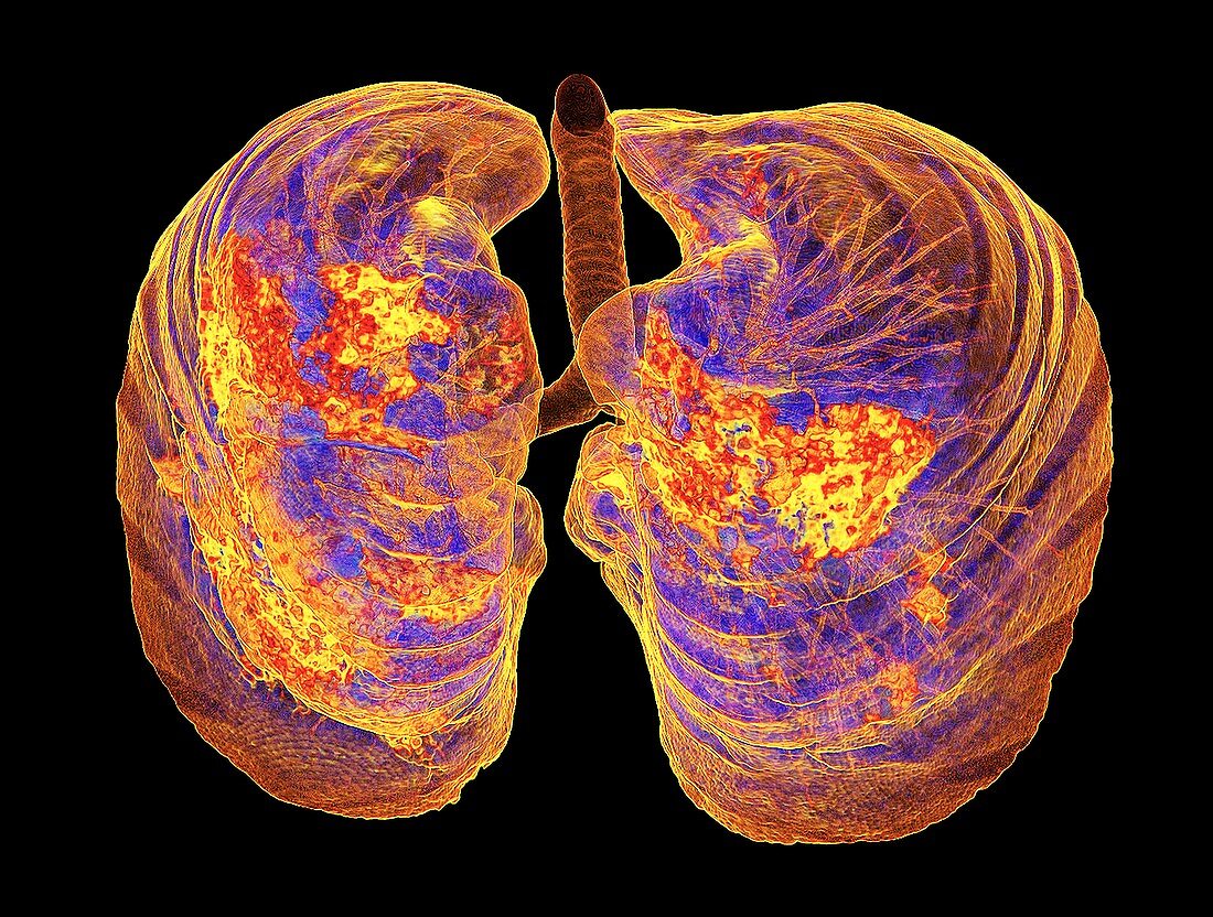 Lungs affected by Covid-19 atypical pneumonia, 3d CT scan