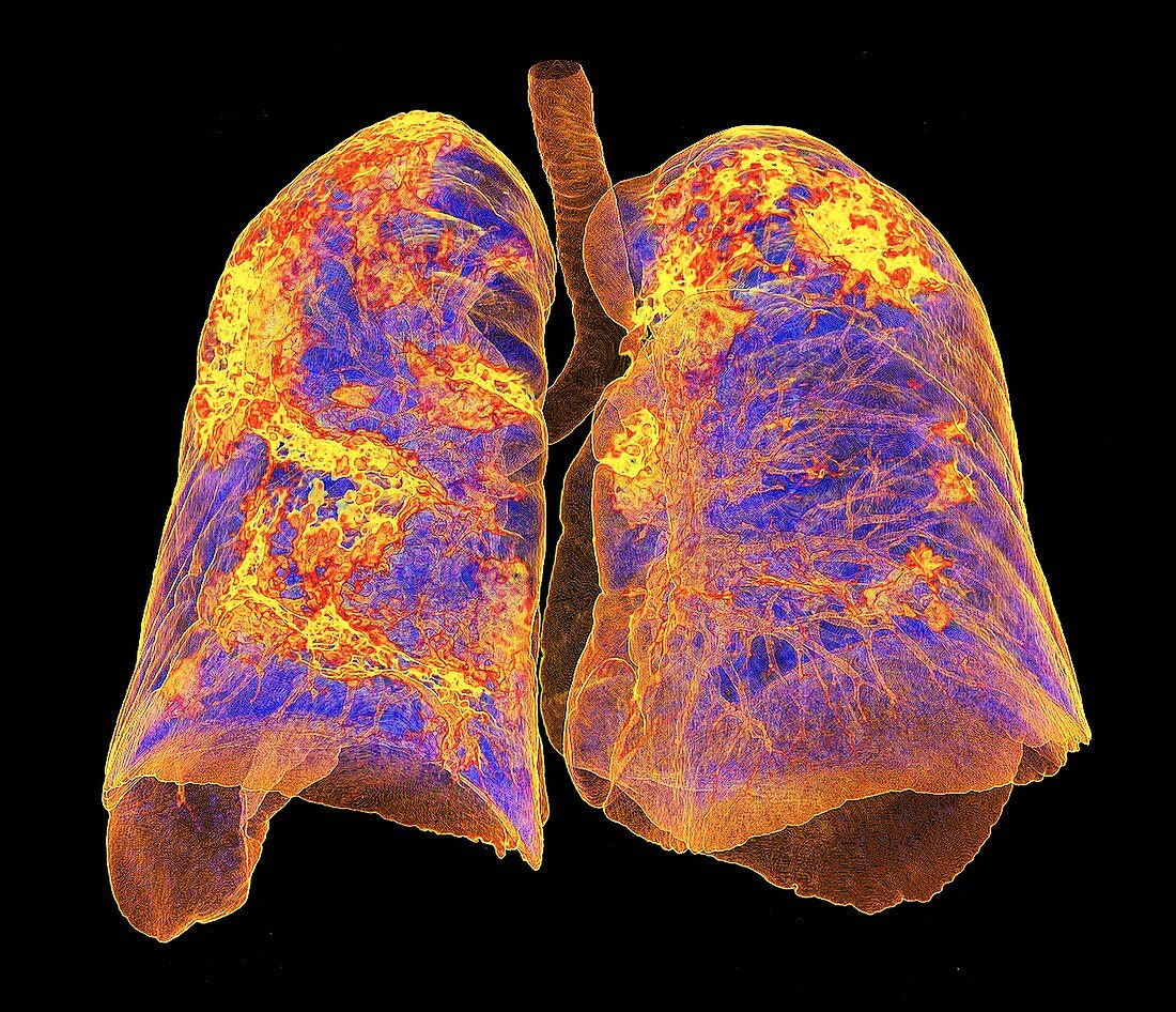 Lungs affected by Covid-19 atypical pneumonia, 3d CT scan