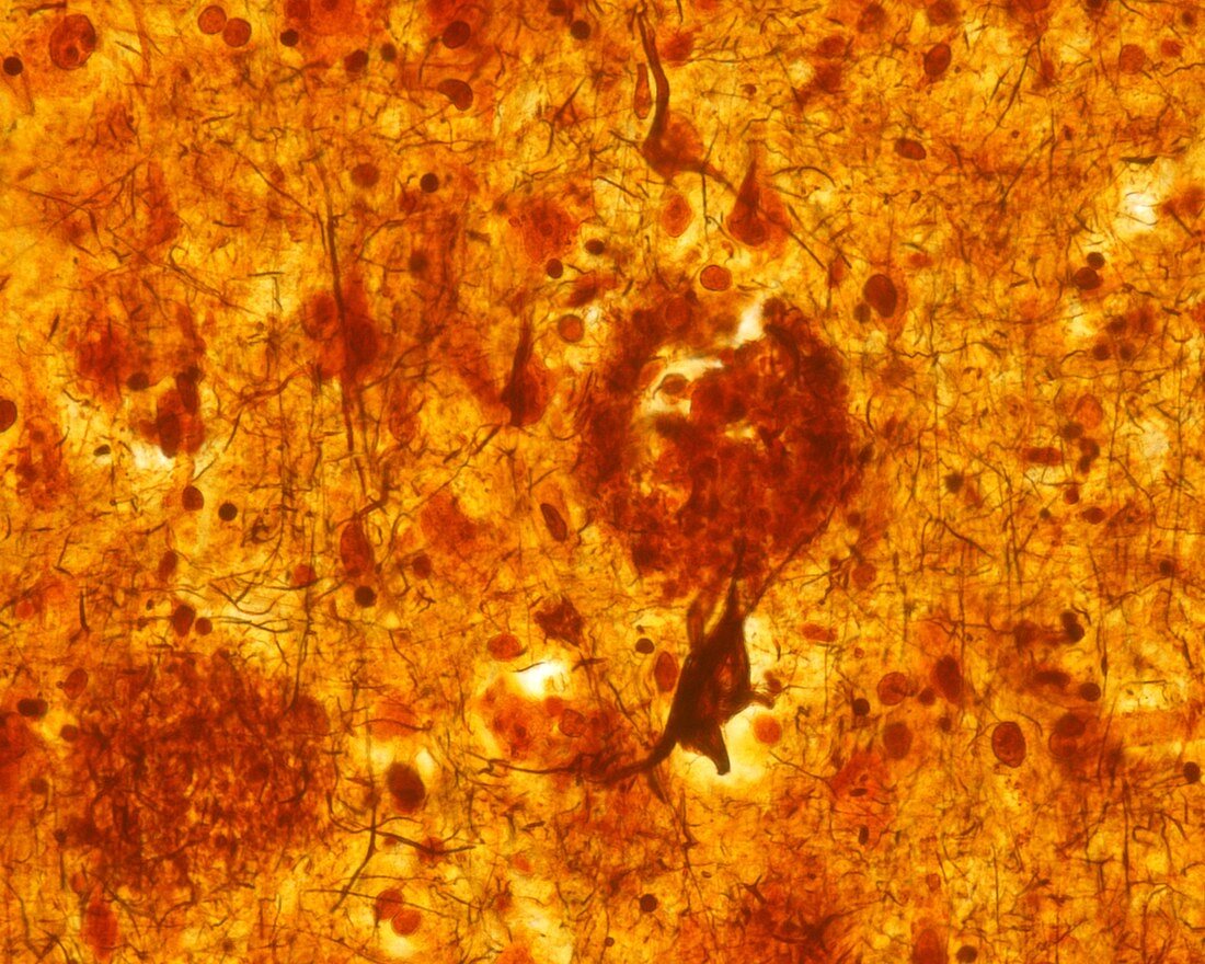 Neurofibrillary tangles, light micrograph
