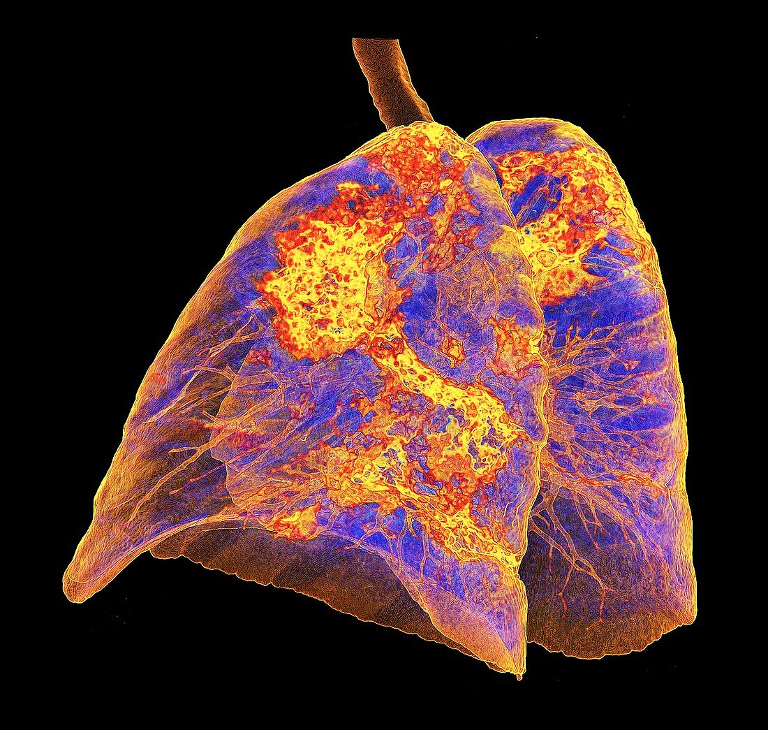 Lungs affected by Covid-19 atypical pneumonia, 3d CT scan