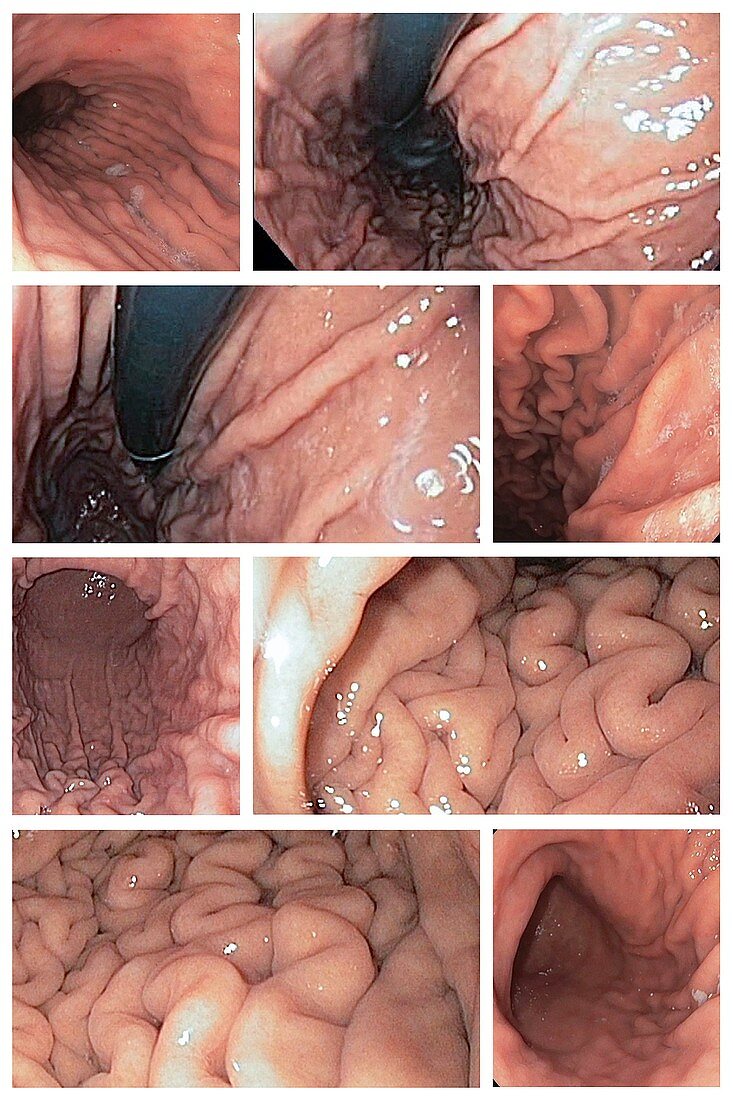 Normal stomach, endoscopy images