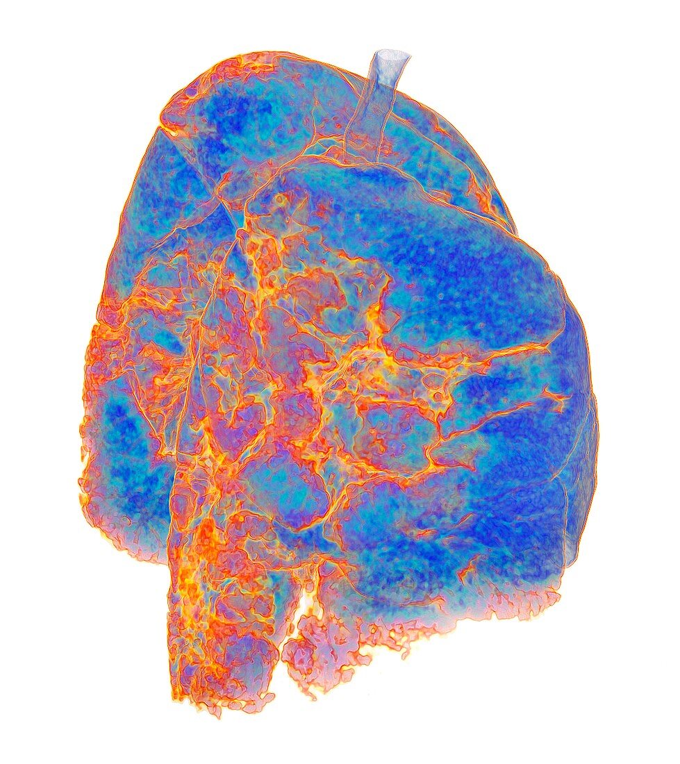 Lungs affected by Covid-19 atypical pneumonia, 3D CT scan