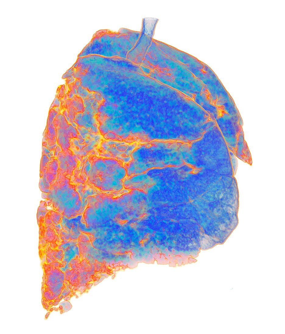 Lungs affected by Covid-19 atypical pneumonia, 3D CT scan