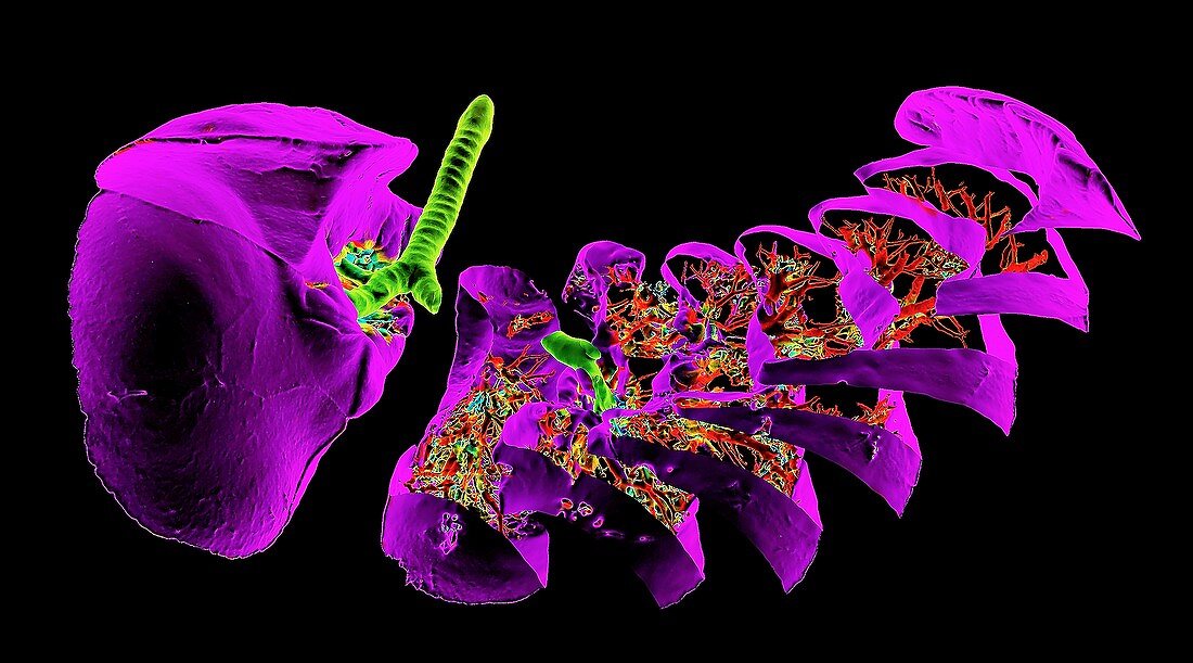 Lungs affected by Covid-19 atypical pneumonia, 3D CT scan