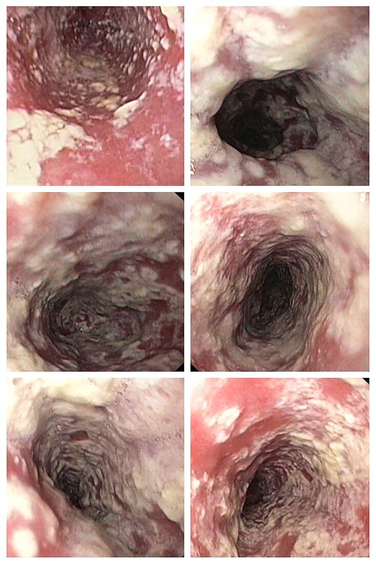 Oesophageal candidiasis, endoscopy images