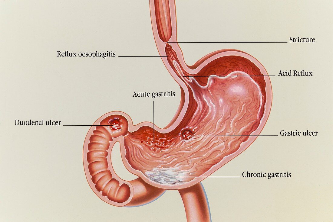 Gastric and duodenal ulcers and acid reflux, illustration