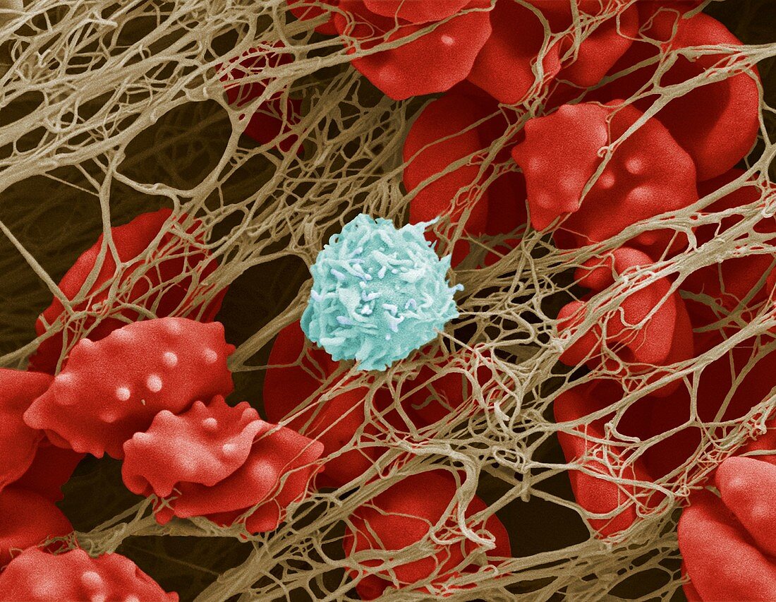 Crenated red blood cells in blood clot, SEM