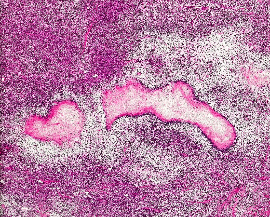 Benign spindle cell tumour of the breast, light micrograph