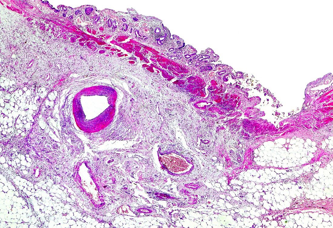 Chronic cholecystitis in the gallbladder, light micrograph