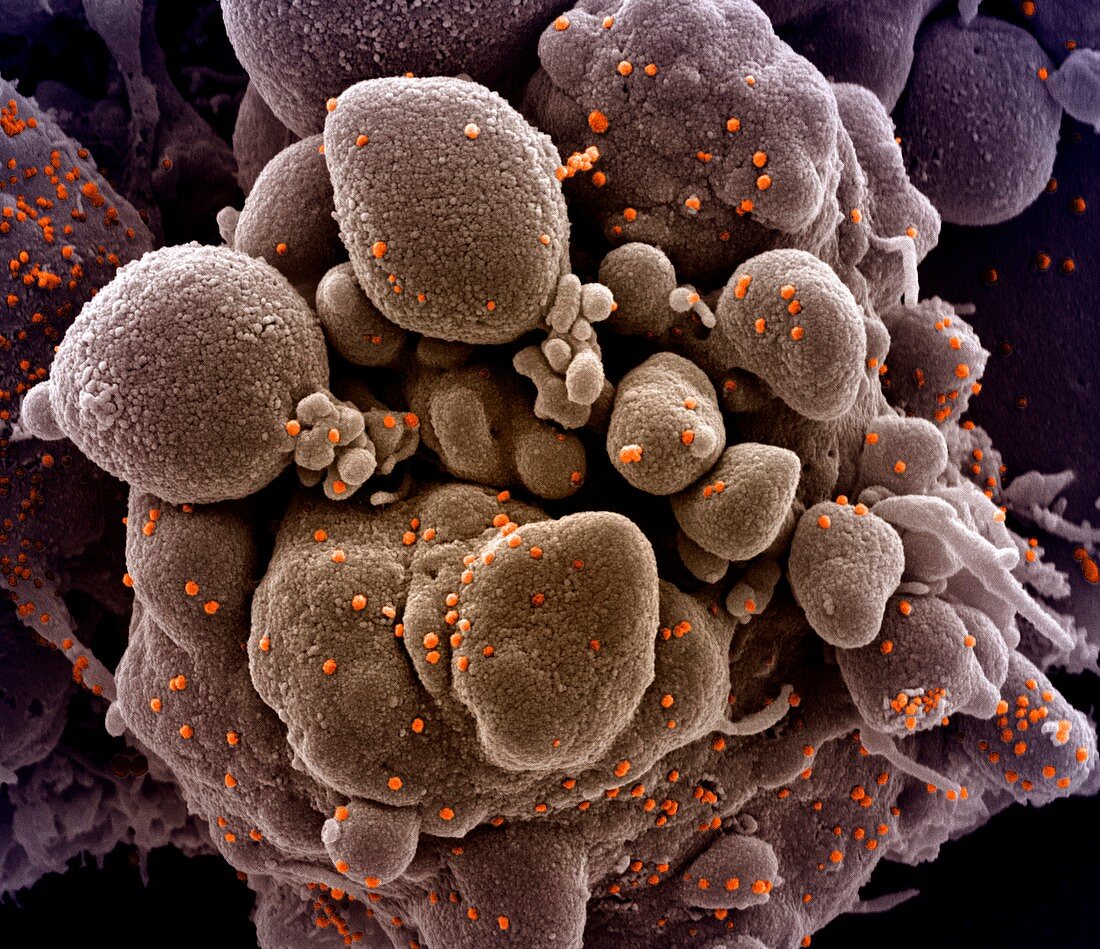 Cell infected with Covid-19 coronavirus particles, SEM