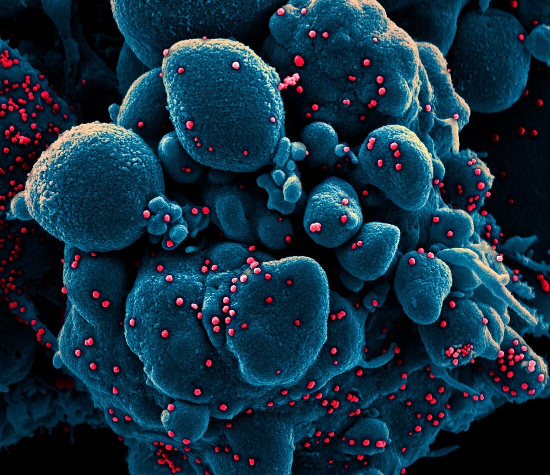 Cell infected with Covid-19 coronavirus particles, SEM