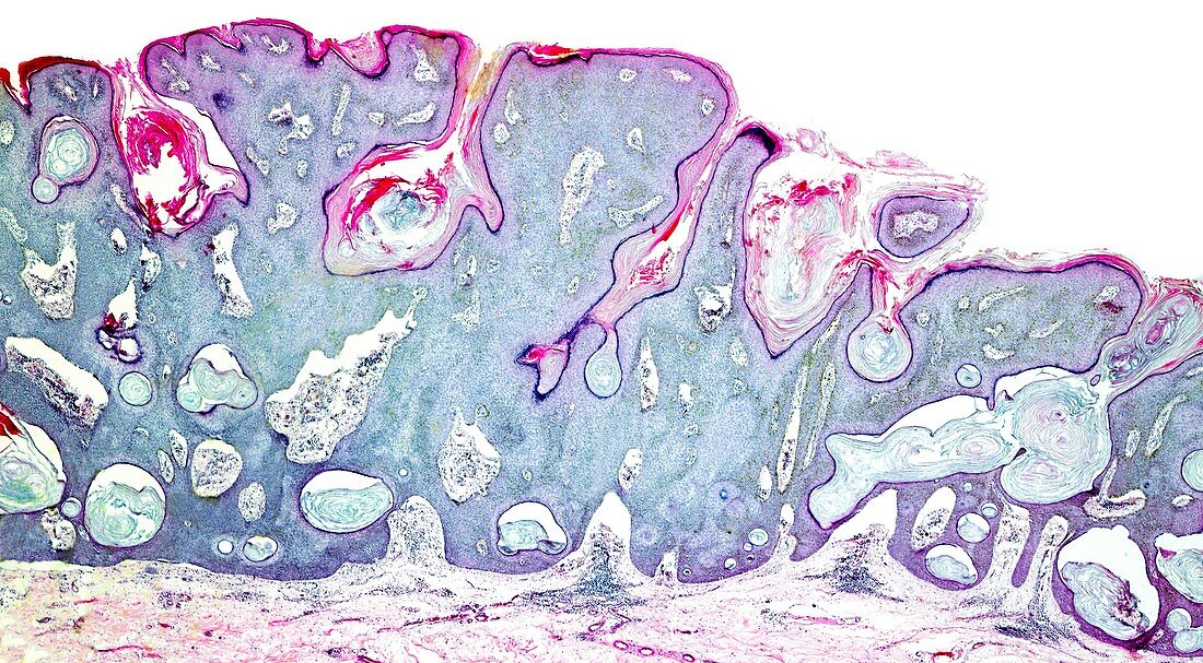 Squamous papilloma of the skin, light micrograph