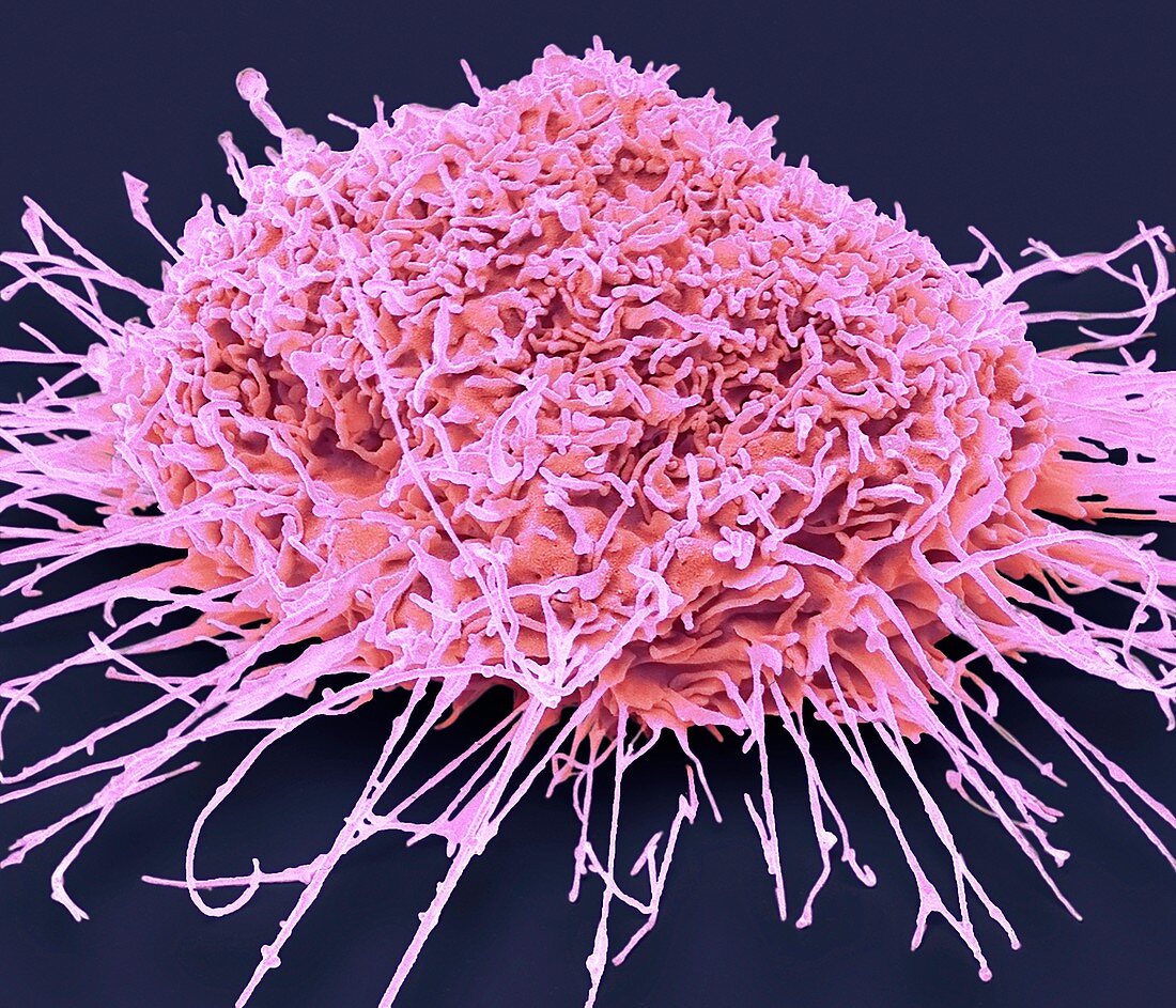 Lung cancer cell, SEM