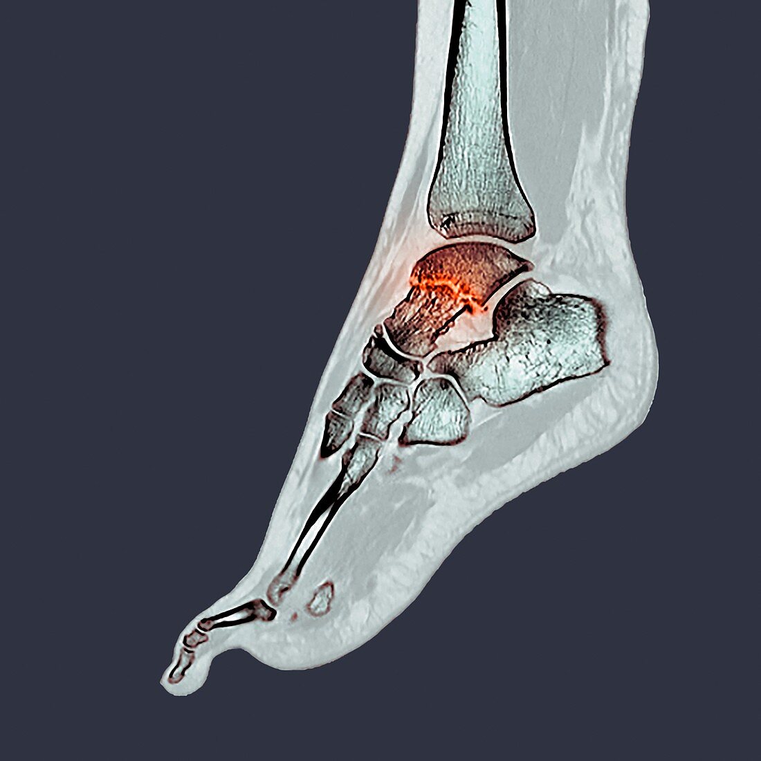 Fractured ankle bone, CT scan