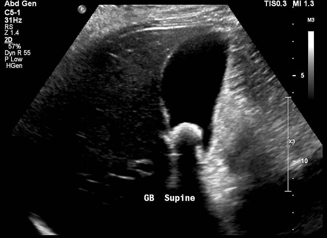 Gallstone, ultrasound scan