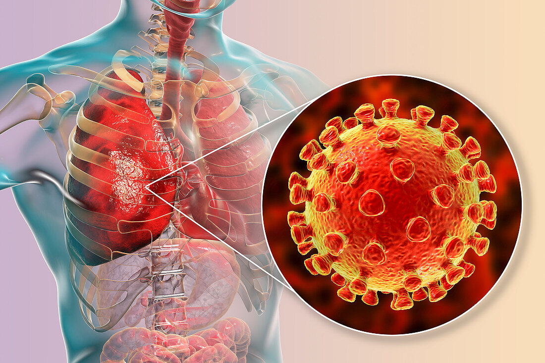 Coronaviruses causing pneumonia, illustration