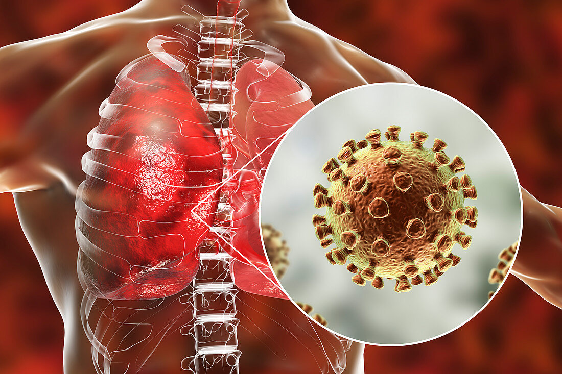 Coronaviruses causing pneumonia, illustration