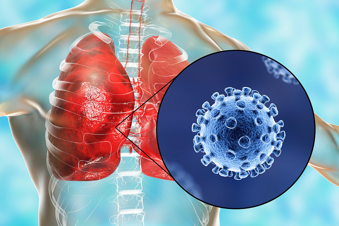 Coronaviruses causing pneumonia, illustration