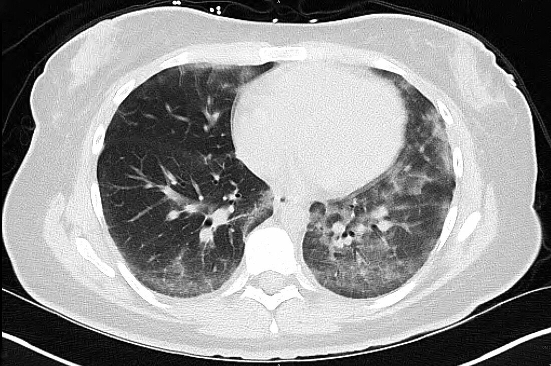Lungs with vaping damage, CT scan