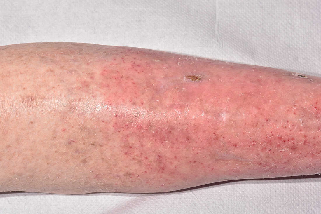 Cellulitis and varicose eczema