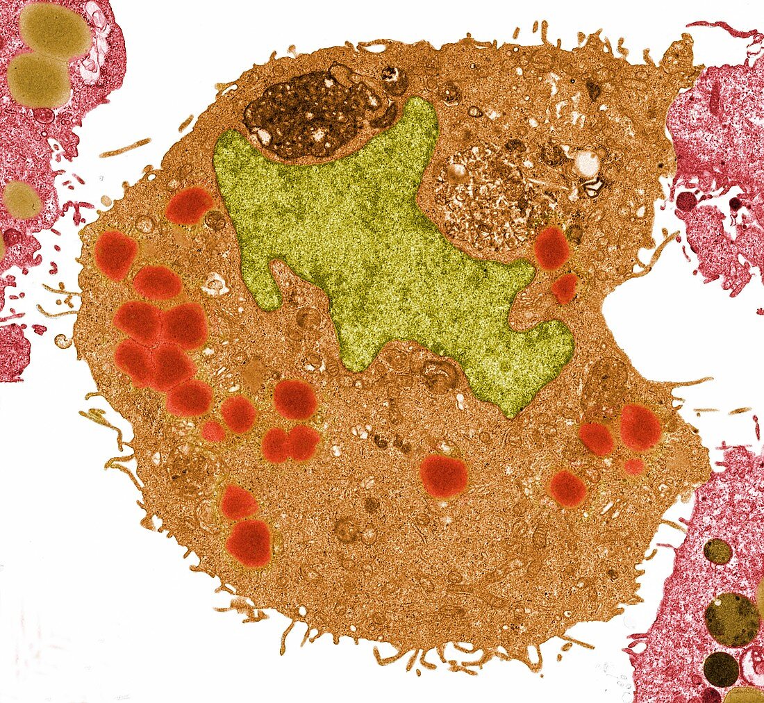 Bladder cancer cell, TEM