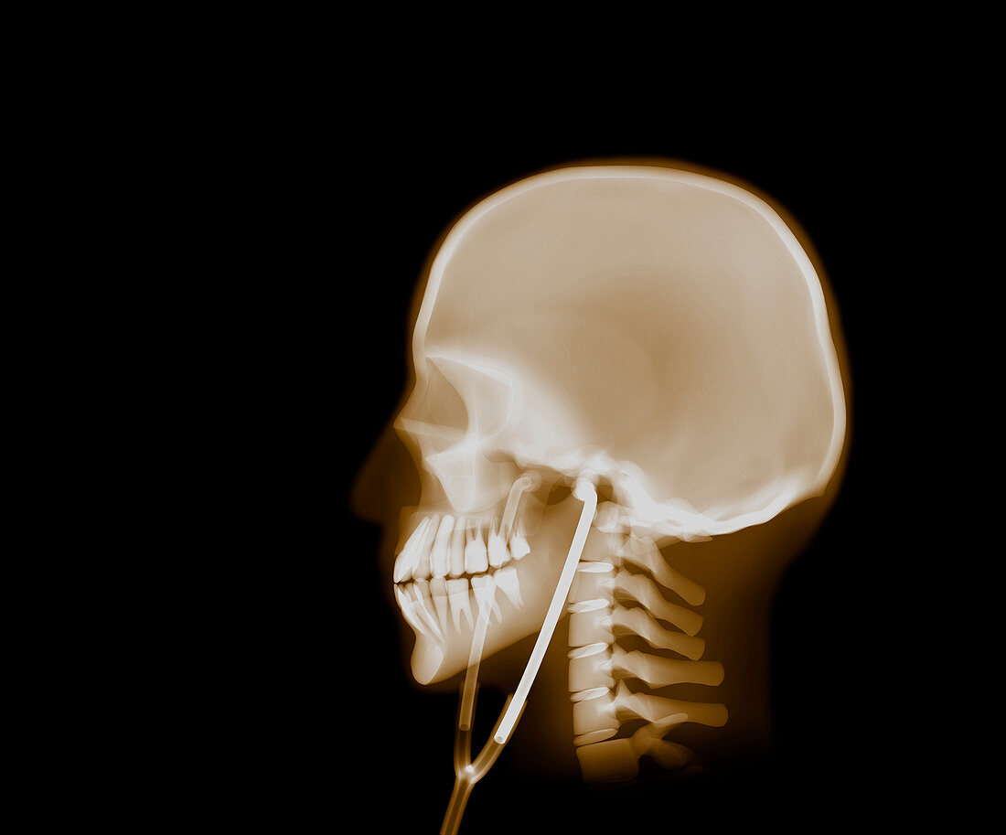 Skull with stethoscope, X-ray