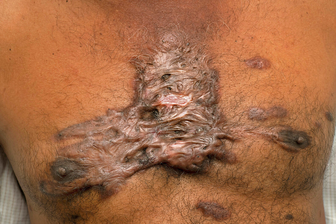 Keloid scar