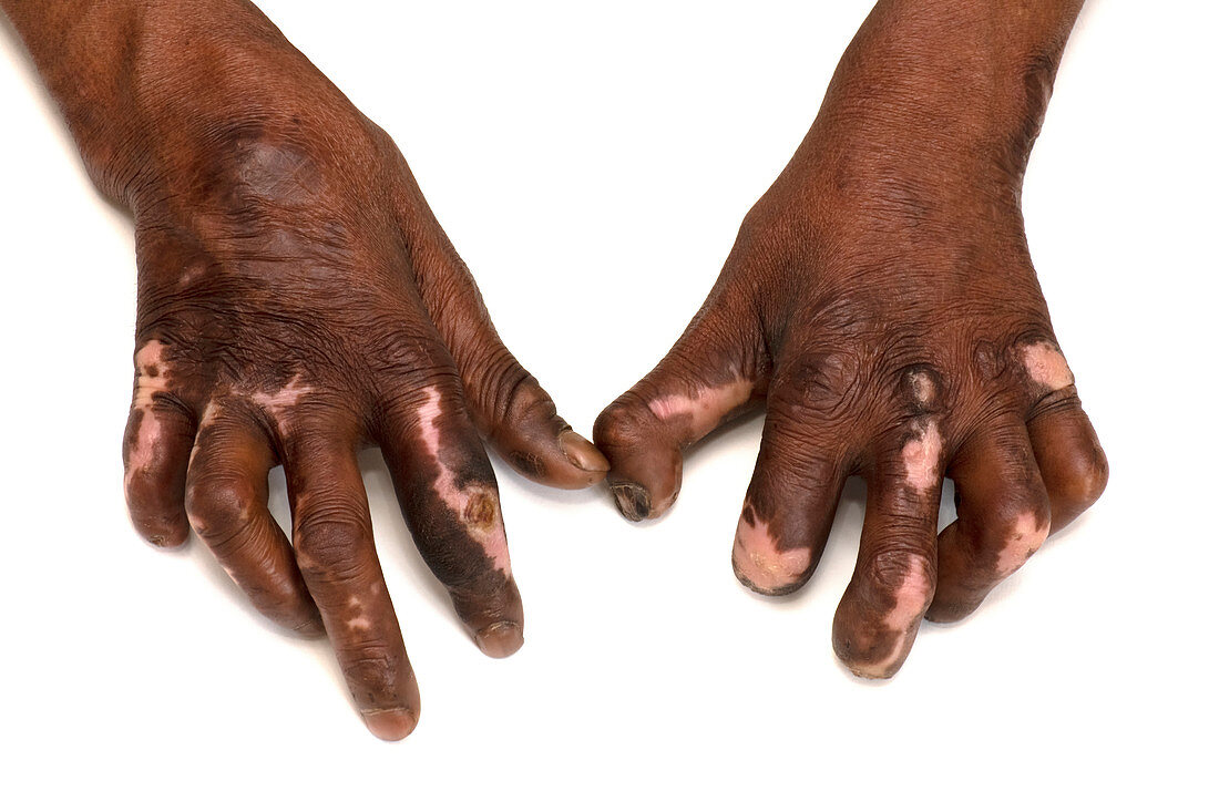 Hands affected by leprosy