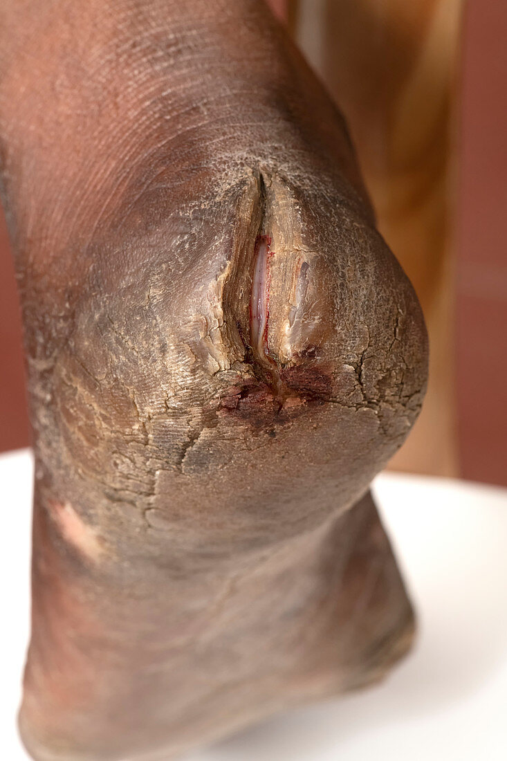 Foot affected by leprosy