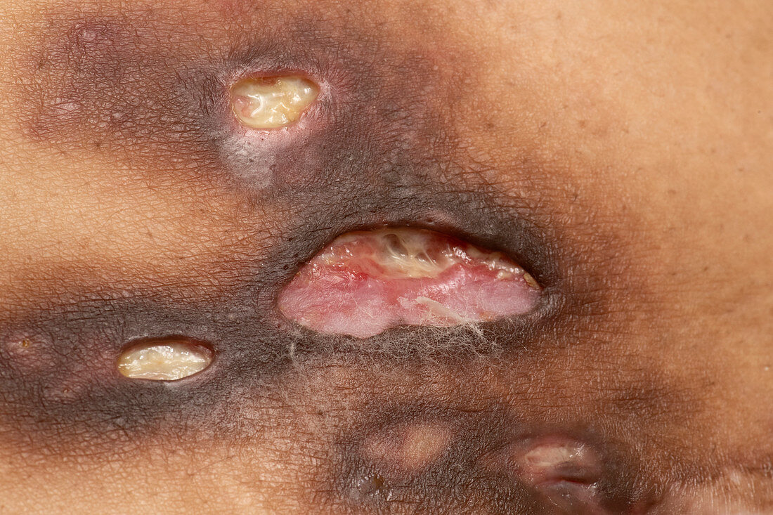 Panniculitis skin disorder
